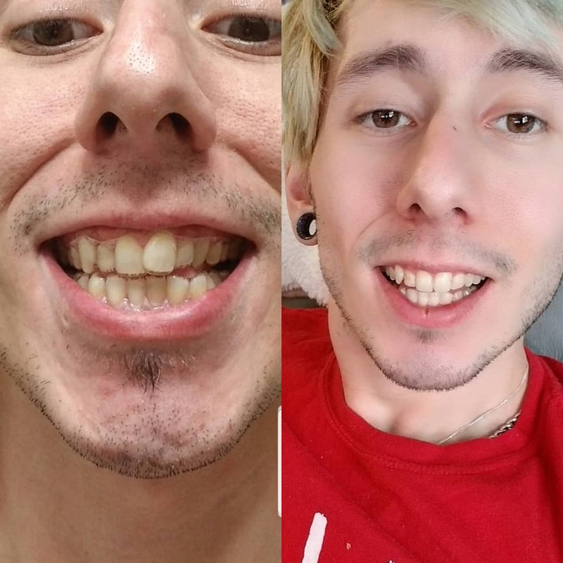 Before and after smile transformation