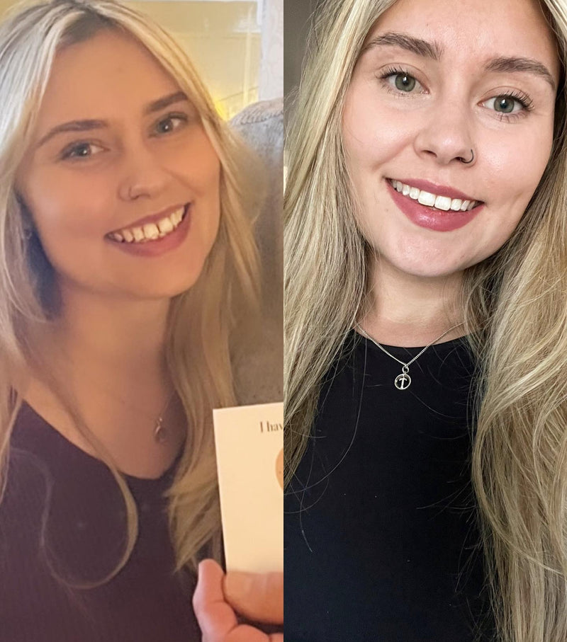 Before and after smile transformation