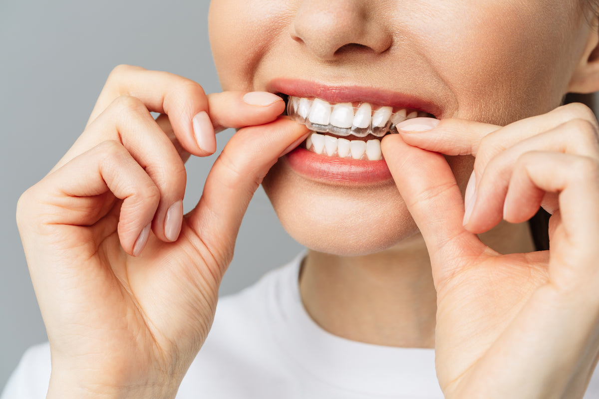 Full Aligner Treatment