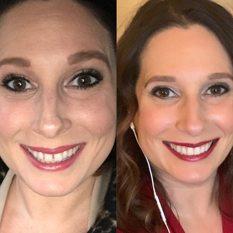 Before and after smile transformation