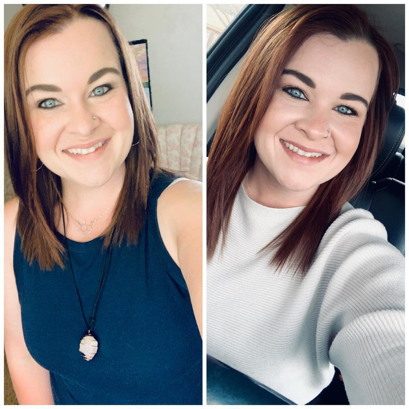 Before and after smile transformation