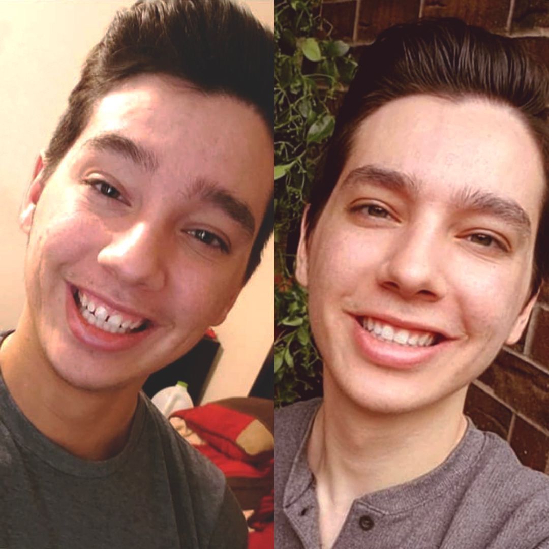 SmileSet Results You Can Trust: Before & After | SmileSet