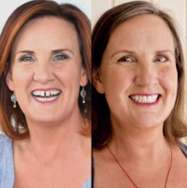Smile Direct Club