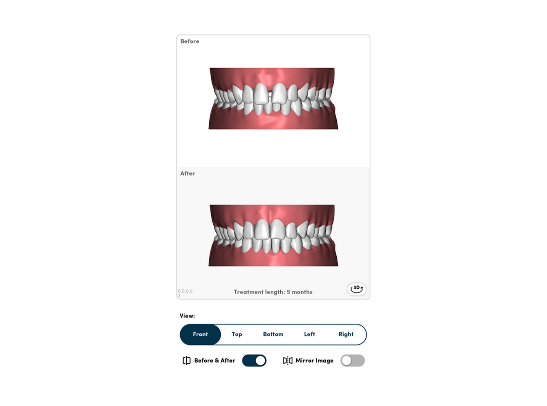 SmileSet treatment plan video cover