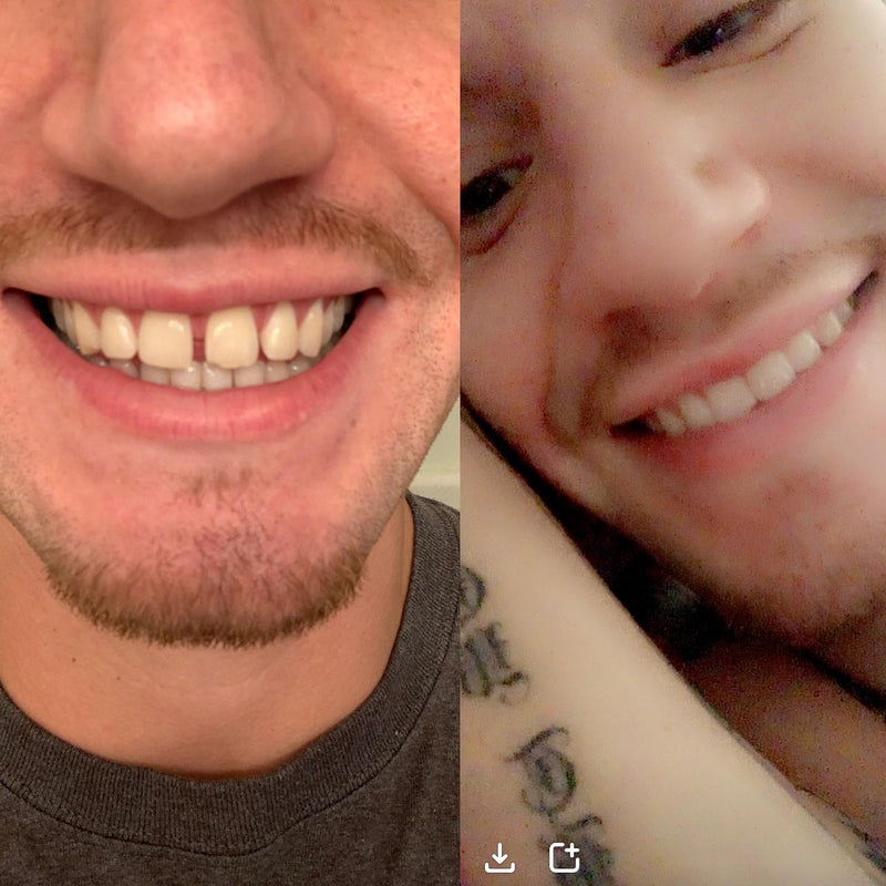 Before and after smile transformation
