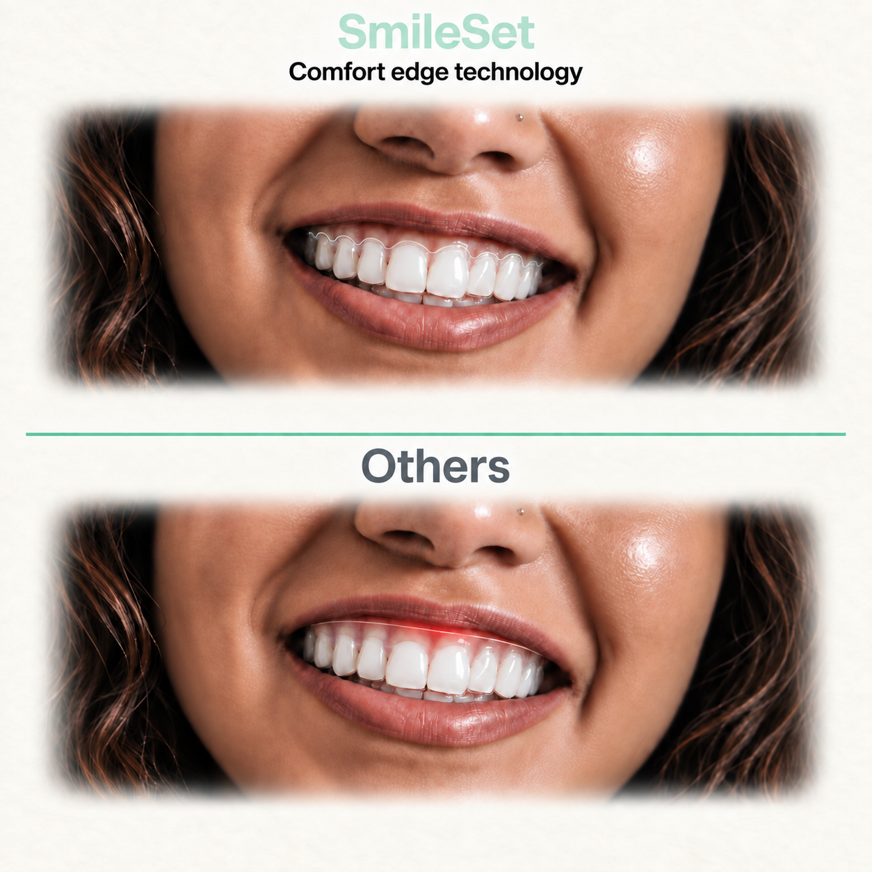 Aligner Treatment