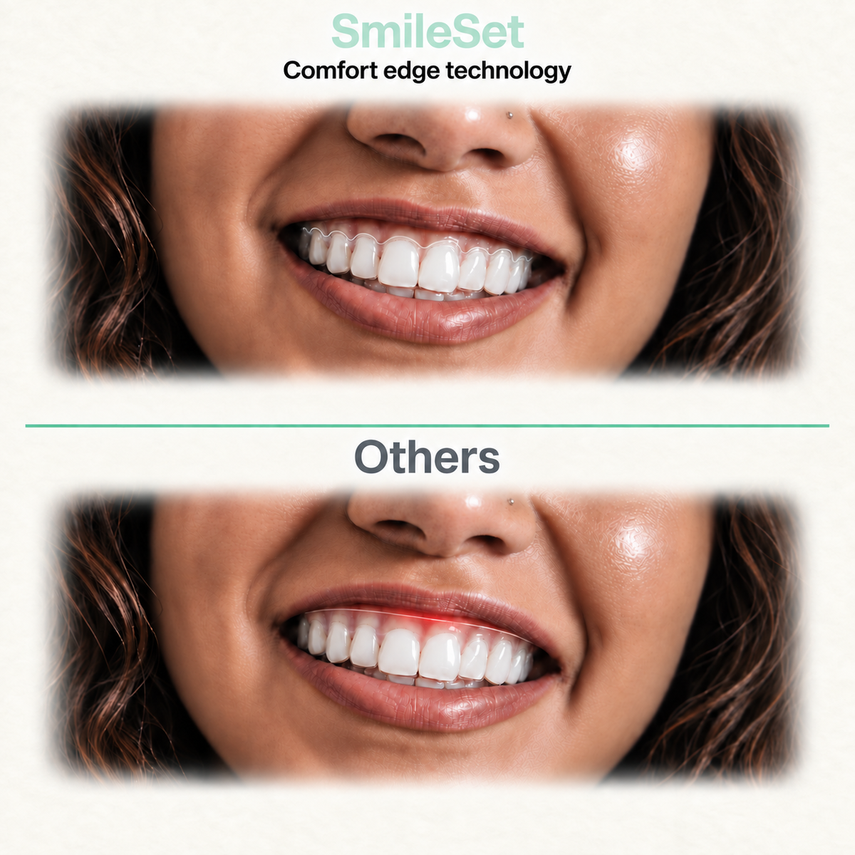 Aligner Treatment
