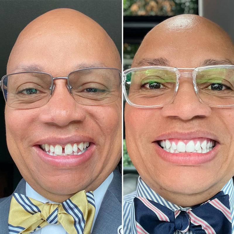 Before and after smile transformation