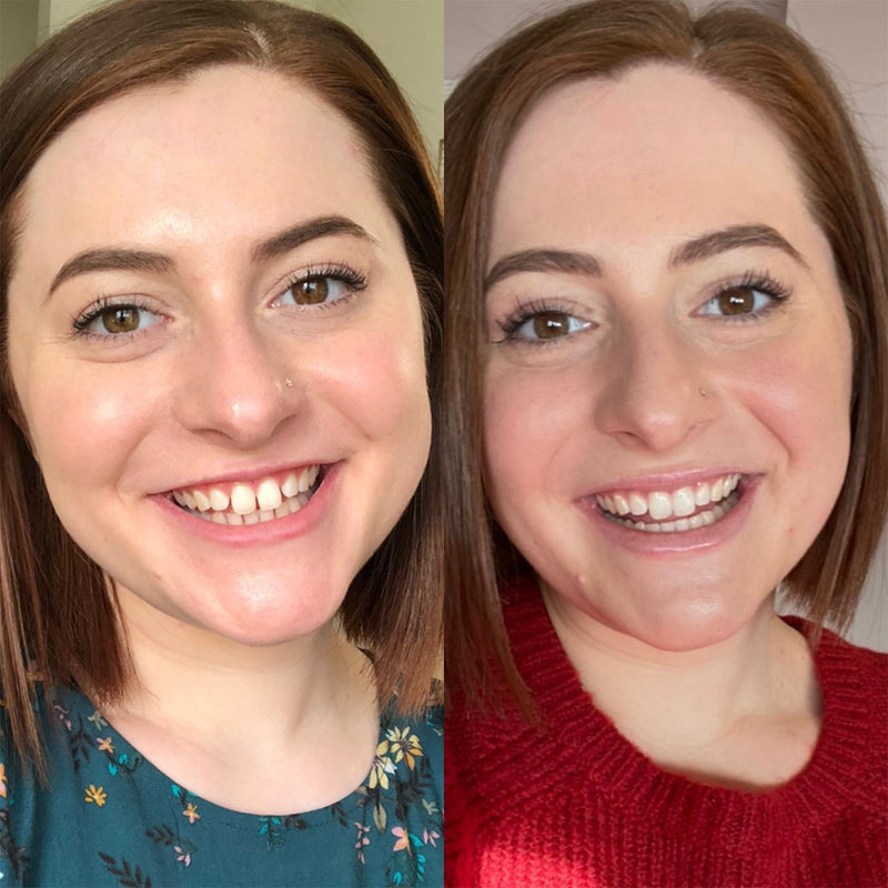 Before and after smile transformation