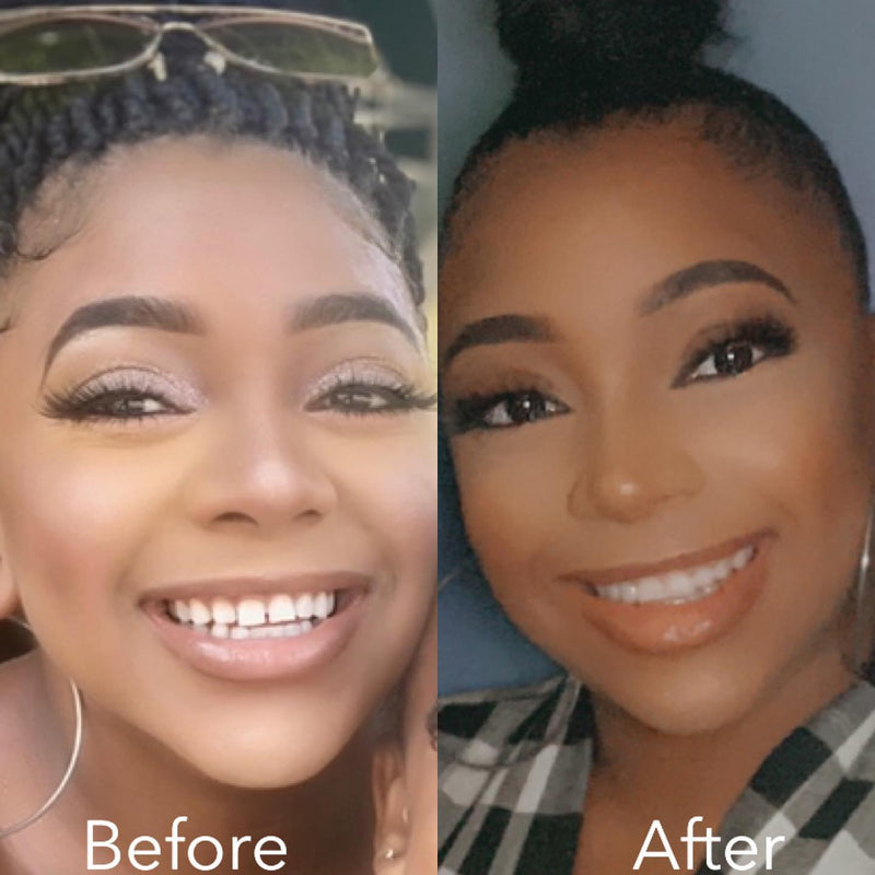 Before and after smile transformation