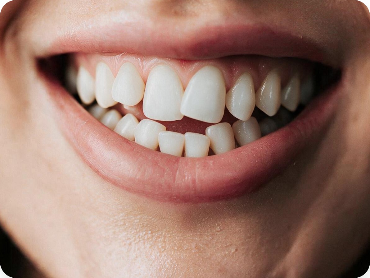 Smile with crowded front teeth