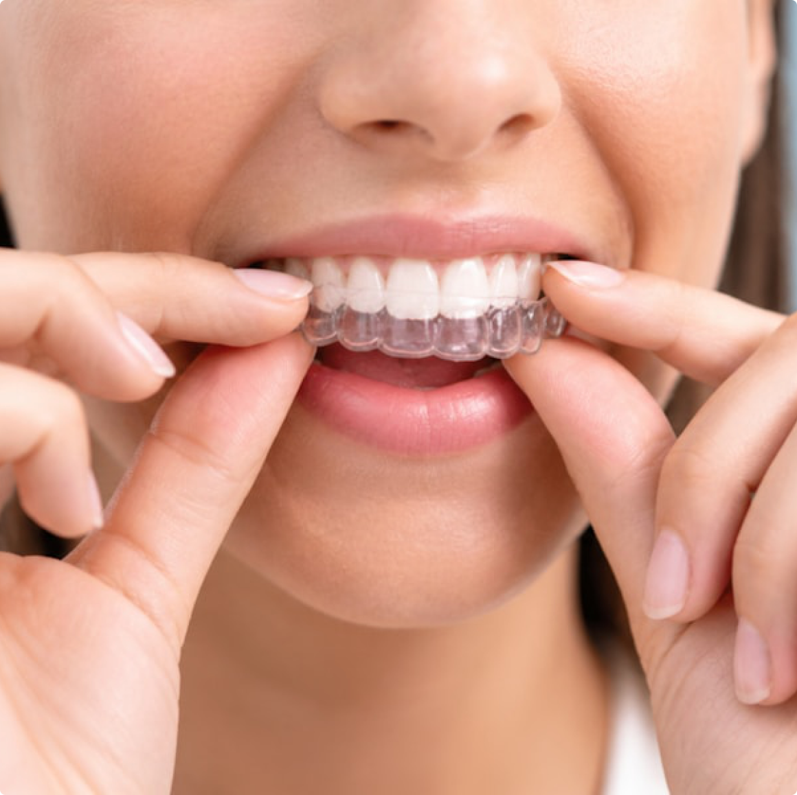 Placing a clear aligner