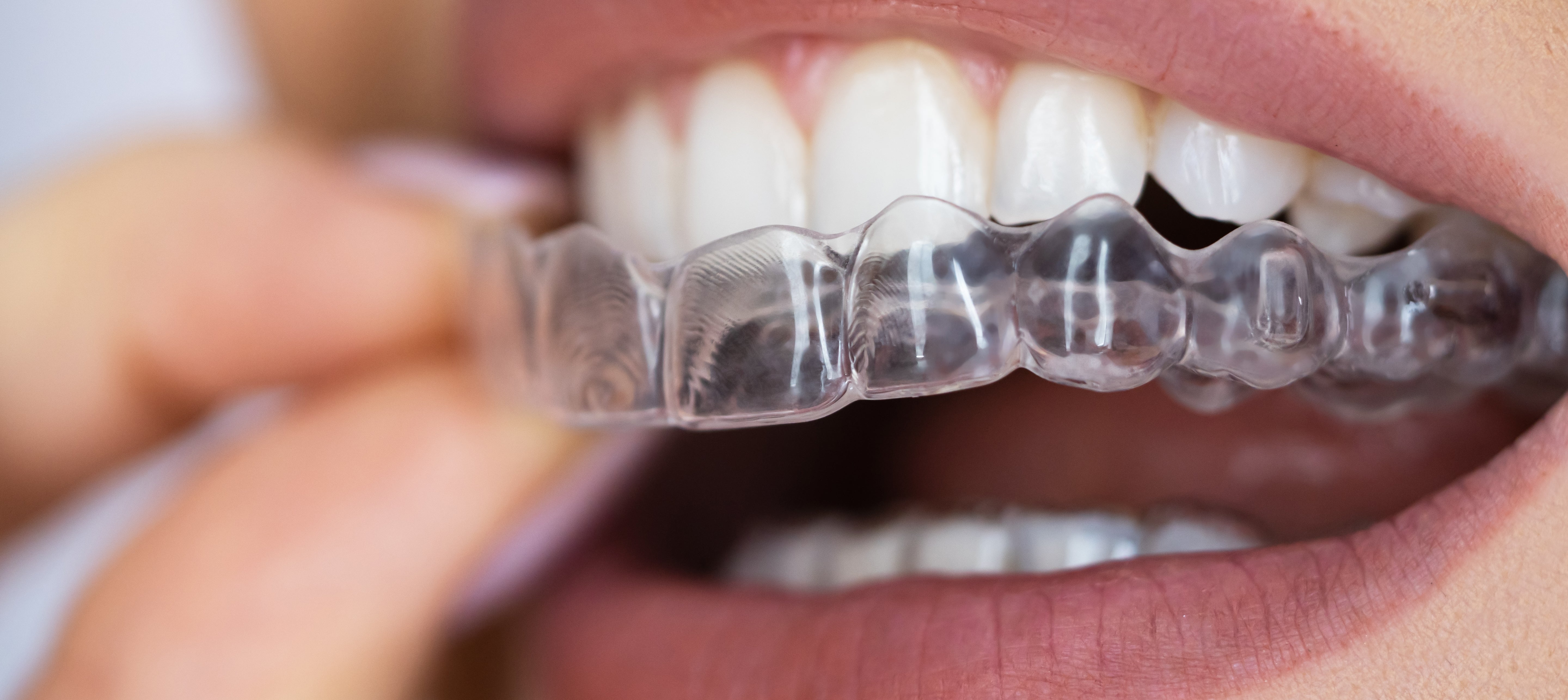 Aligner Treatment