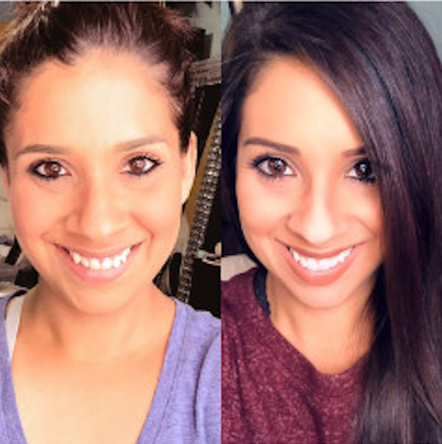 Before and after smile transformation
