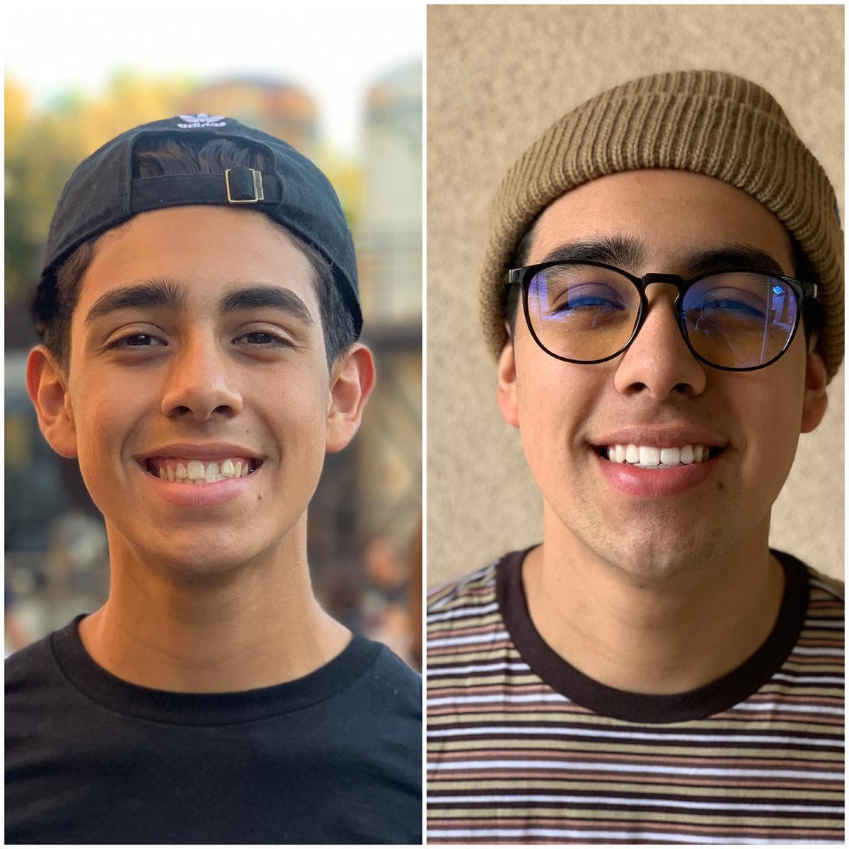 Aligner Treatment